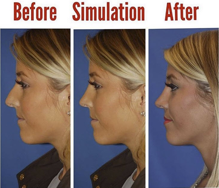 Rhinoplasty in Portland