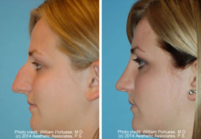 Nose Surgery