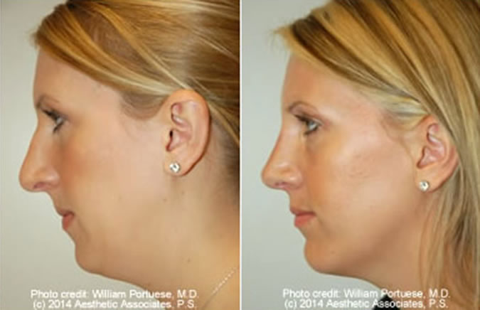 Nose Surgery