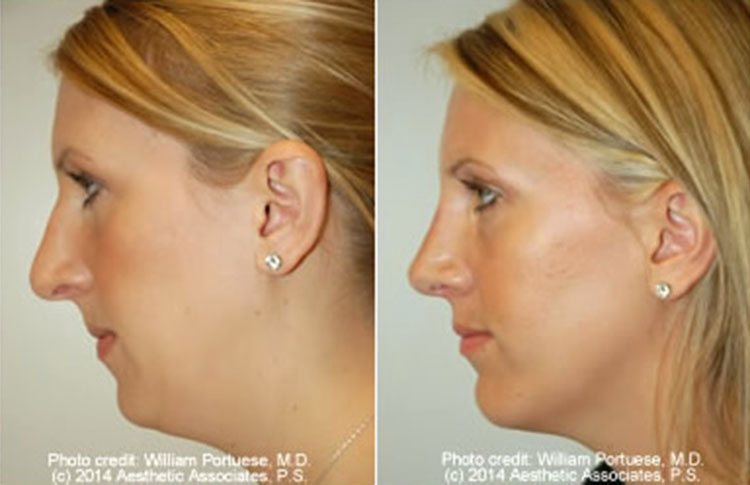 Nose Surgery