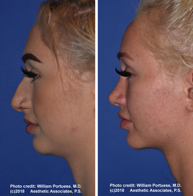 Nose Surgery Pacific Northwest