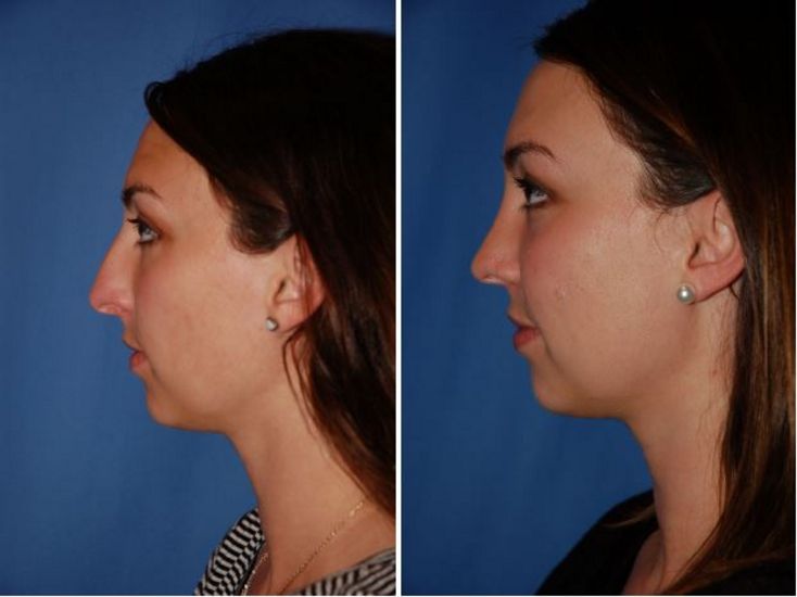 Nose Surgeon Portland Or