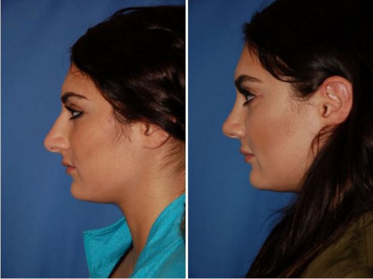 Dermal Fillers Portland Oregon