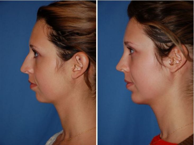 Rhinoplasty Portland Oregon