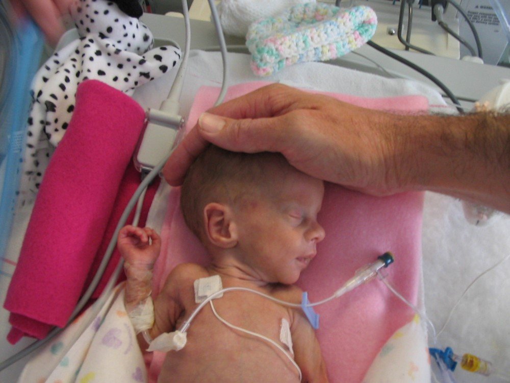Preemies Prove 'Viability' Standard Wrong