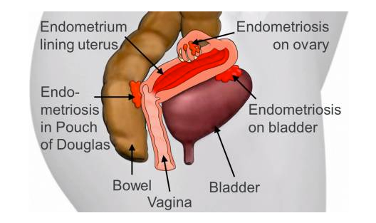 La endometriosis duele sin regla La endometriosis duele sin regla