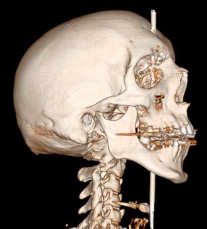 Suicide à l’arbalète 2dcfe757-suicide-arbalete-cas-clinique-chirurgie-orl
