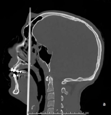 https://storage.googleapis.com/prd-blogs/2020/02/73ca858f-suicide-arbalete-cas-clinique-chirurgie-orl-reconstruction-3d-scanner-tete-cou.jpg