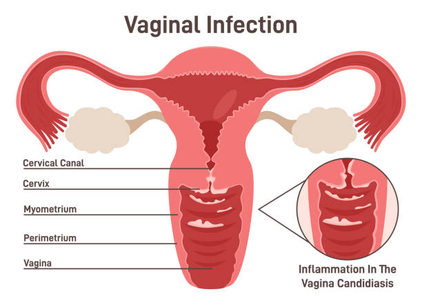 demostration of vaginal infection