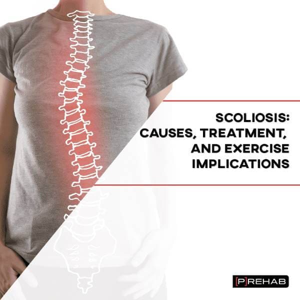 SCOLIOSIS - CAUSES, TREATMENT, AND EXERCISE IMPLICATIONS
