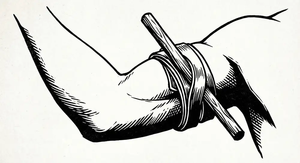 An improvised tourniquet applied to an upper arm using a belt and windlass