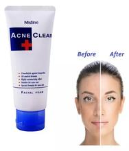 Mistine Acne Clear Facial Foam - 85gm