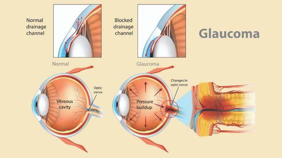 Why is National Glaucoma Awareness Month observed in January?