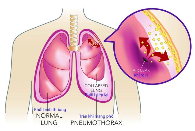 Cách điều trị tràn dịch màng phổi