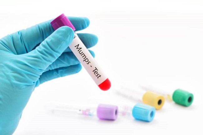 What Does the Mumps Test Mean?