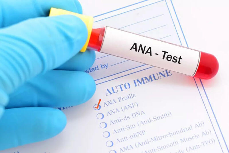 The ANA Test Is of Great Importance in The Diagnosis of Autoimmune Diseases