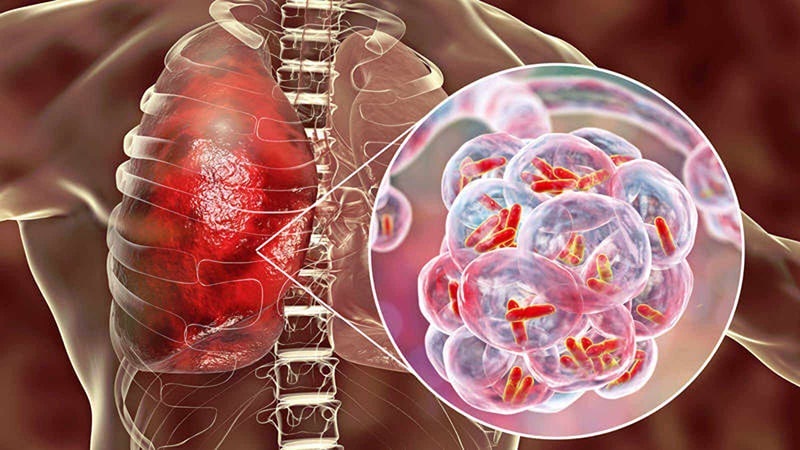 Xét nghiệm Quantiferon có chính xác và đáng tin cậy không?
