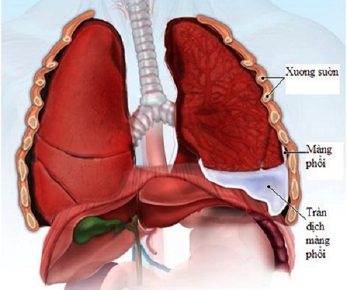 Tìm Hiểu Cách Điều Trị Tràn Dịch Màng Phổi Hiệu Quả Hiện Nay - Diag