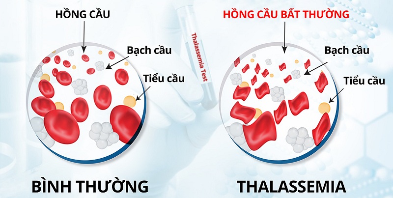 Nguyên nhân gây ra bệnh tan máu bẩm sinh là gì?
