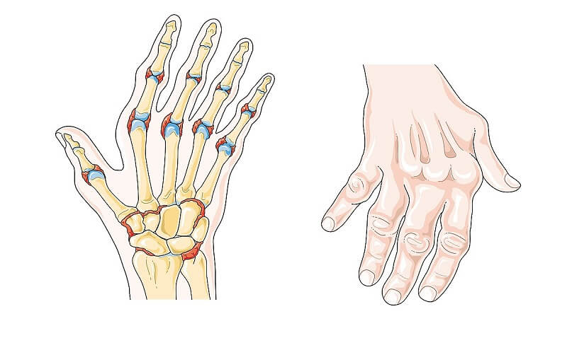 Viêm Khớp Dạng Thấp Có Những Phương Pháp Điều Trị Nào? - Diag