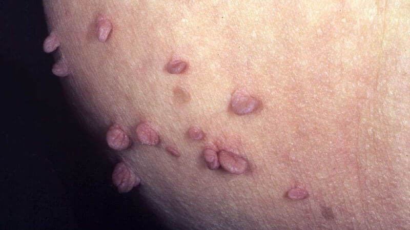 vaginal warts