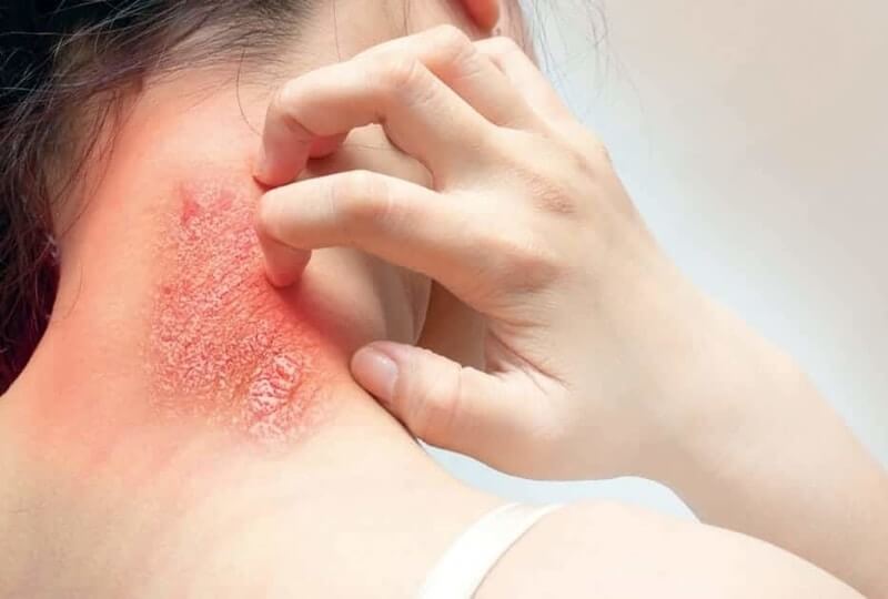 Eczema loại nào thường đi kèm với viêm nhiễm da?
