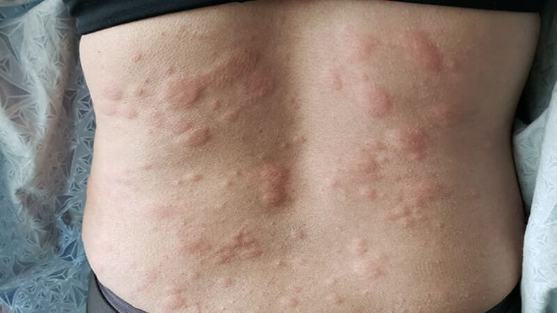 is-liver-disease-causes-itchy-skin-danger-diag