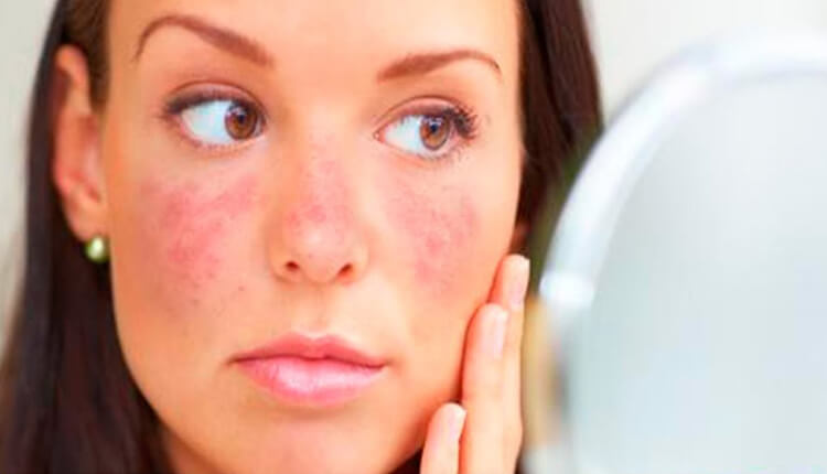 Xét nghiệm nào khác cần được thực hiện để chẩn đoán Lupus ban đỏ ngoài xét nghiệm ANA?
