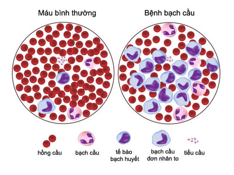 Quy trình chuẩn bị trước khi thực hiện xét nghiệm ung thư máu ở trẻ em?
