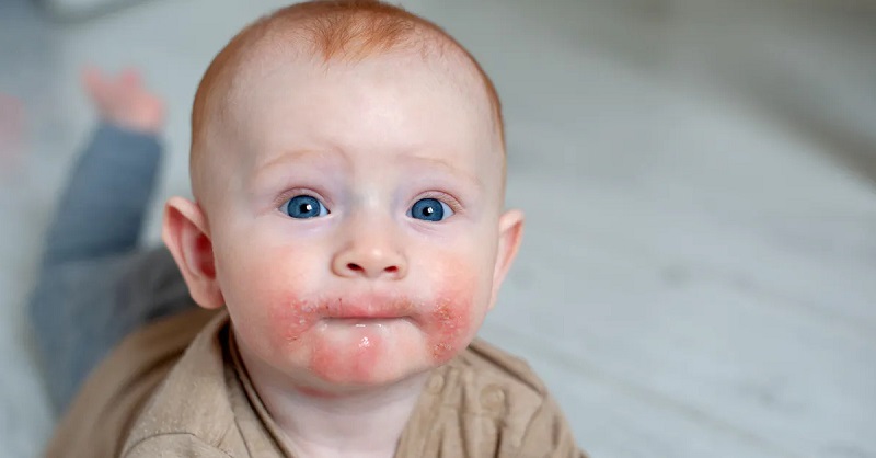 Eczema types nào thường xảy ra ở trẻ em?
