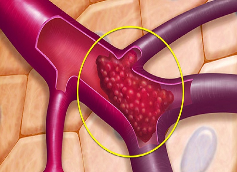 Hội chứng antiphospholipid có ảnh hưởng đến thai nhi không?
