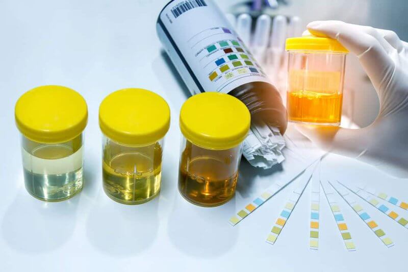 How Do I Understand The Results Of A Urine Test? - Diag