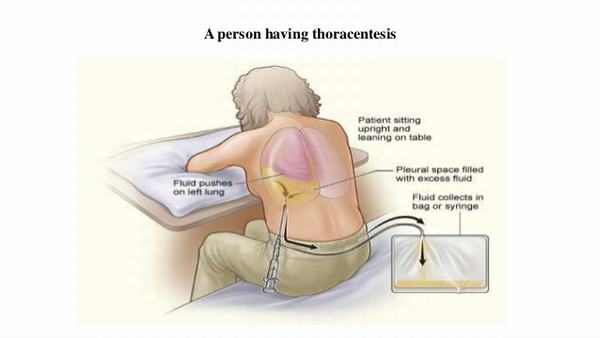 pleural effusion treatment