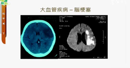 669.腦中風 (下)