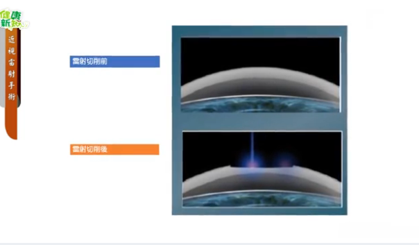 488. 近視雷射手術