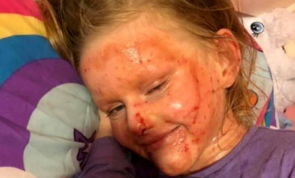 Mom’s Fight Against Daughter’s Severe Eczema Shines Light On Mental Health Impact‌
‌