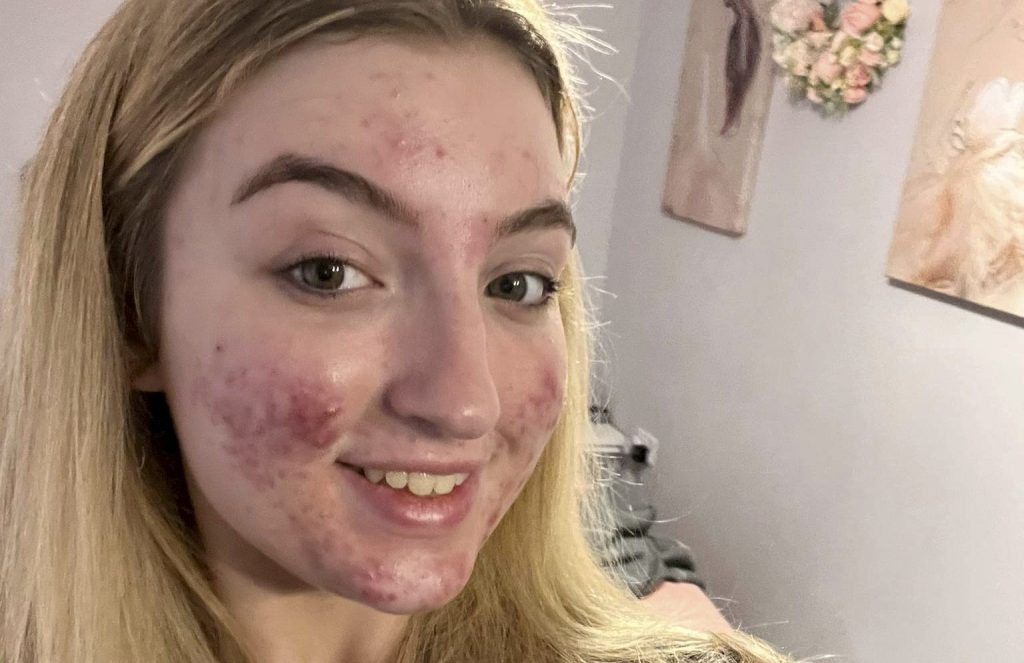 Eva Grant, 16, with no makeup, showed her acne. A teenage beauty queen has said her Tiktok account was shut down because her cystic acne was branded as gruesome content. TINA GRANT/SWNS TALKER