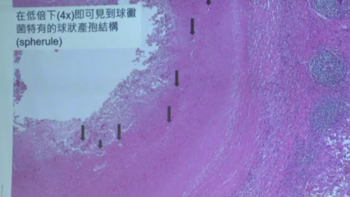 球黴菌病例增加 疾管署:去風險國家著掛喙罨