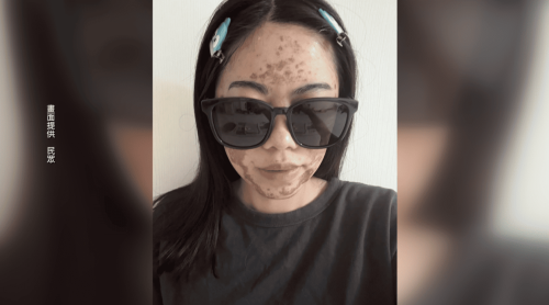 欲變媠煞險險仔毀容 診所用過期水果酸化妝品