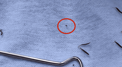 70外歲男性 致著「發熱伴堅血球減少綜合症」