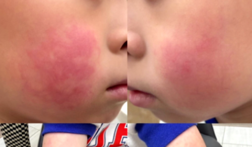 日本蘋果病當咧流行 症頭若感冒 目前無預防射