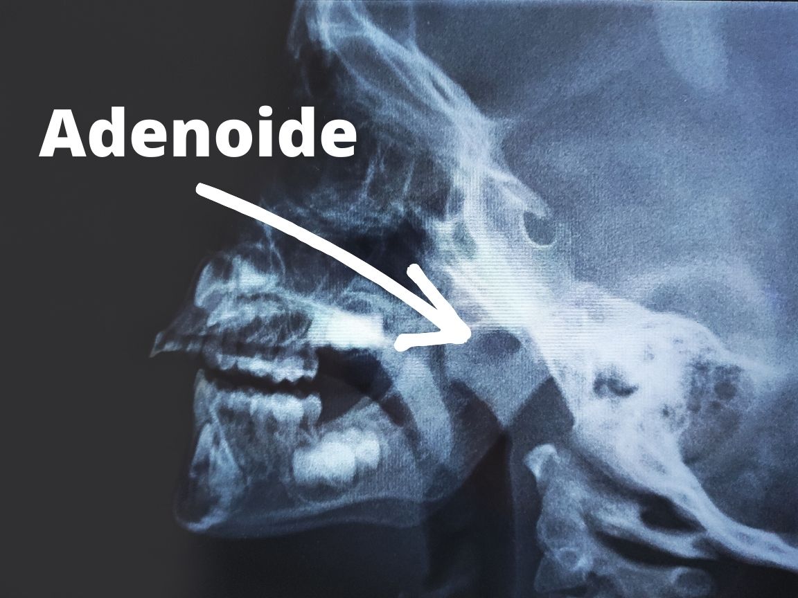 Adenoide-raio-x-de-cavum.jpg