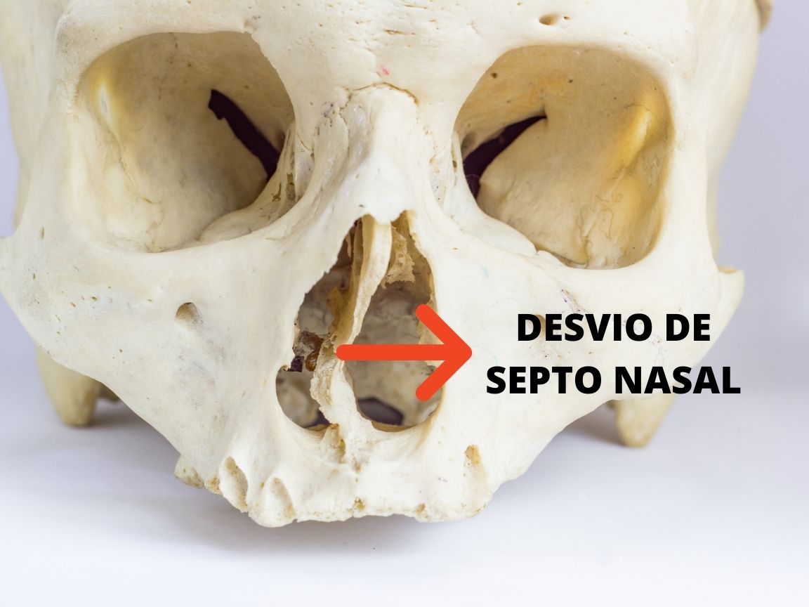 DESVIO-DE-SEPTO-NASAL.jpg