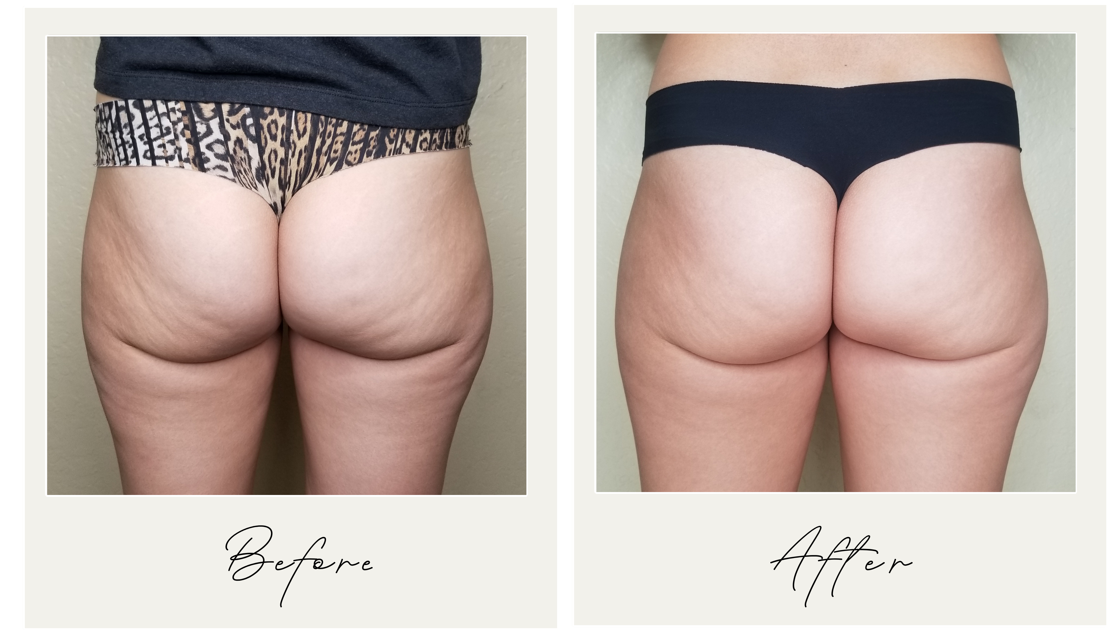 total.sculpting Check this CRYOSKIN TONING transformation and these  legs!🔥😮 This is Cryoskin's power: diminish cellulite, tighte