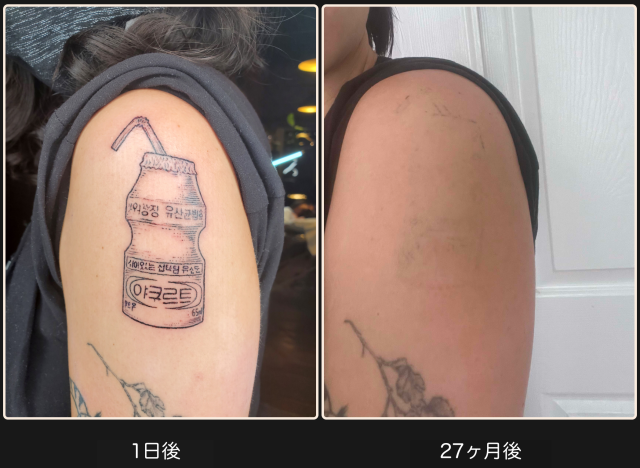 tattoo エフェメラルインク✖️3 エフェメラルタトゥー日本代理店｜3年で消えるタトゥー