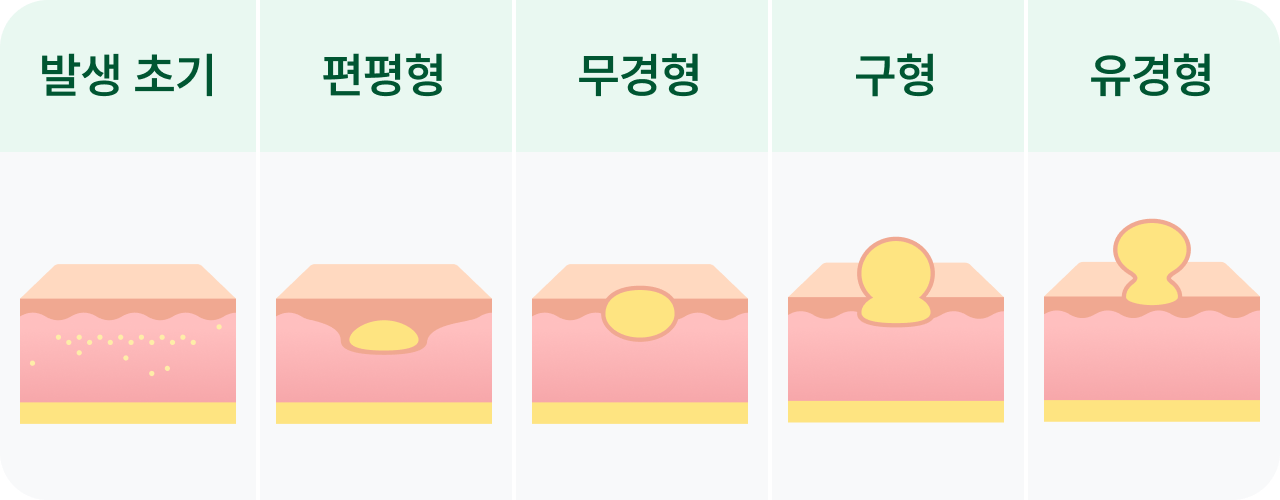 피부 신경섬유종, 신경섬유종증 1형