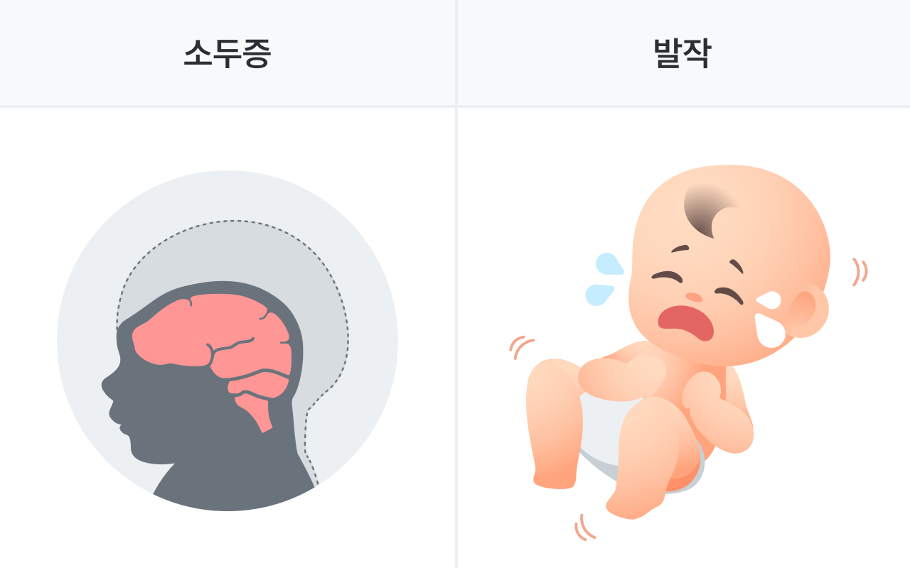 FOXG1 증후군 증상, 소두증, 발작, 영아연축