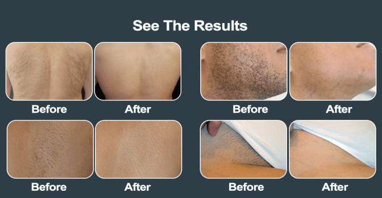 Diode Laser Hair Removal VS. IPL Hair Removal - Spotless Laser