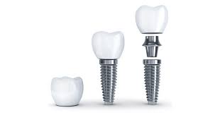 Implant Dentistry