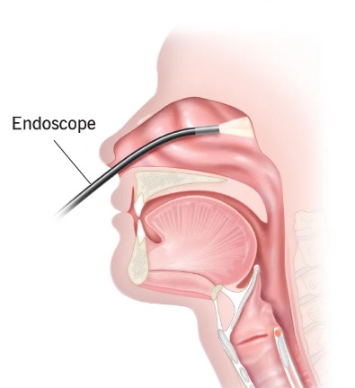 Fibroscopie nasale : Comment est-il mon nez à l'intérieur ? Voici le nez et  sinus vus par caméra